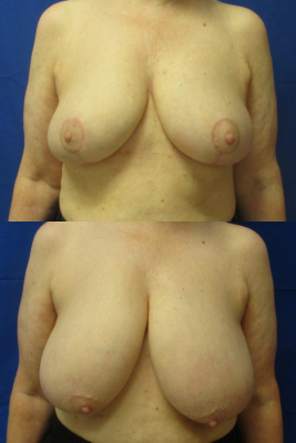 breast reduction before & after