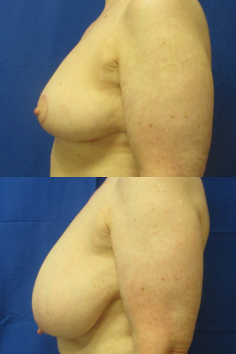 breast reduction before & after