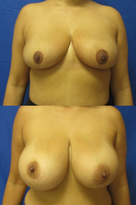 breast reduction before & after
