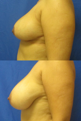 breast reduction before & after