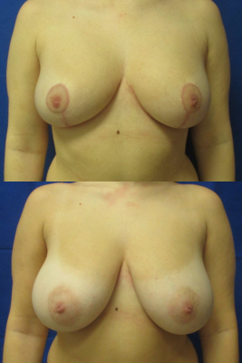 breast reduction before & after