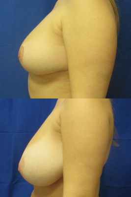 breast reduction before & after