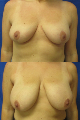 breast reduction before & after
