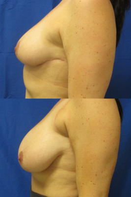 breast reduction before & after