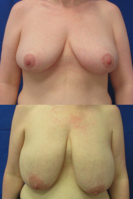 breast reduction before & after