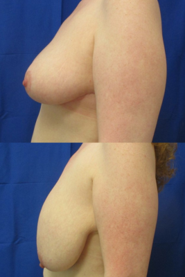breast reduction before & after
