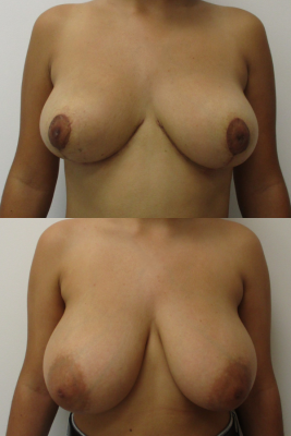 breast reduction before & after
