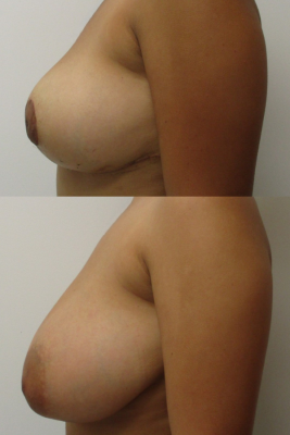 breast reduction before & after