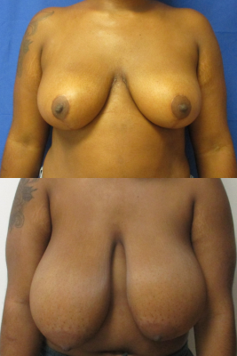 breast reduction before & after