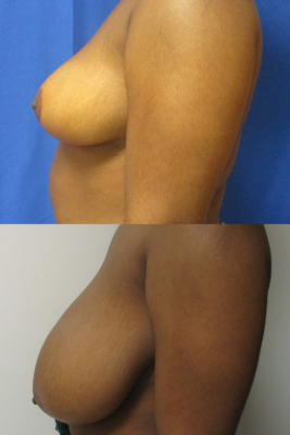 breast reduction before & after