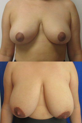 breast reduction before & after