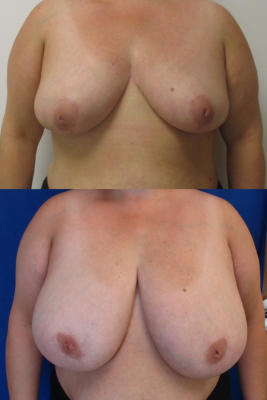 breast reduction before & after