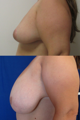 breast reduction before & after