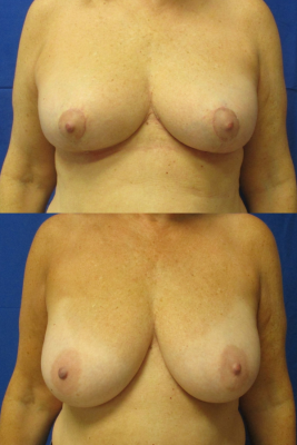 breast reduction before & after