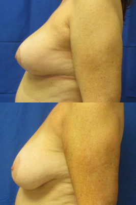 breast reduction before & after