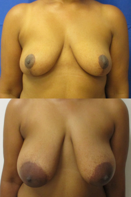 breast reduction before & after