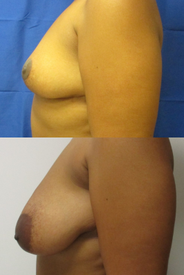 breast reduction before & after