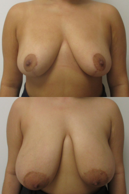 breast reduction before & after