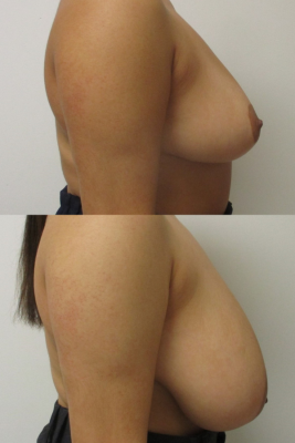 breast reduction before & after