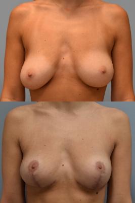 BREAST REDUCTION