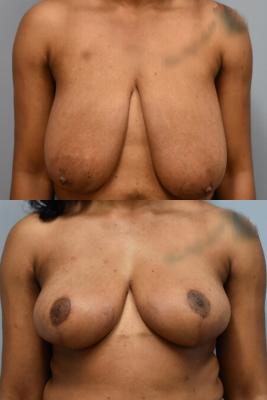 BREAST REDUCTION