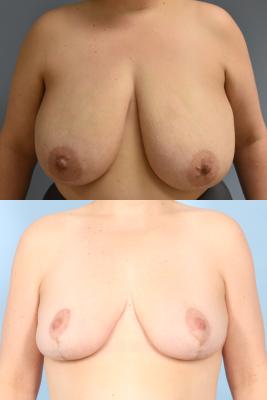BREAST REDUCTION