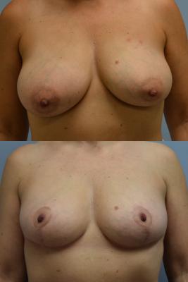 Breast Reduction