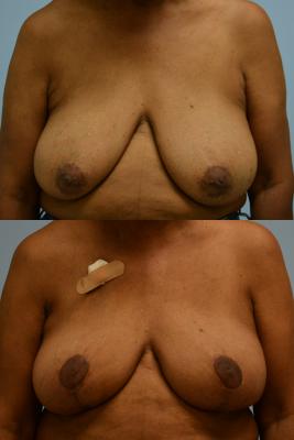 ONCOPLASTIC BREAST REDUCTION