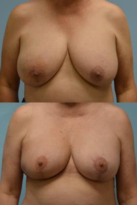 ONCOPLASTIC BREAST REDUCTION