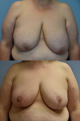 ONCOPLASTIC BREAST REDUCTION