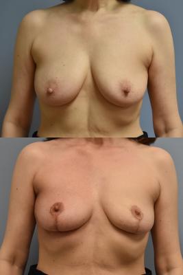 ONCOPLASTIC BREAST REDUCTION