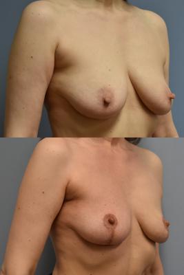 ONCOPLASTIC BREAST REDUCTION
