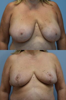 LEFT ONCOPLASTIC BREAST REDUCTION AND RIGHT BREAST REDUCTION FOR SYMMETRY