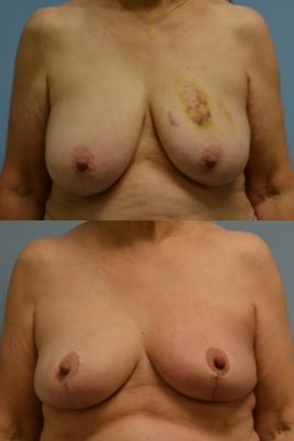 ONCOPLASTIC BREAST REDUCTION