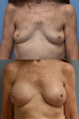 BREAST RECONSTRUCTION WITH TISSUE EXPANDERS AND ADM GRAFT