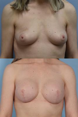 BREAST RECONSTRUCTION WITH TISSUE EXPANDER AND ADM GRAFT