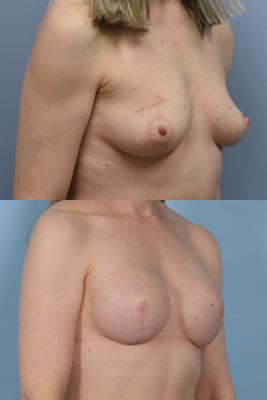BREAST RECONSTRUCTION WITH TISSUE EXPANDER AND ADM GRAFT