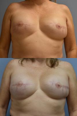 BREAST IMPLANT RECONSTRUCTION REVISION