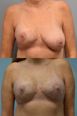 BREAST IMPLANT RECONSTRUCTION REVISION