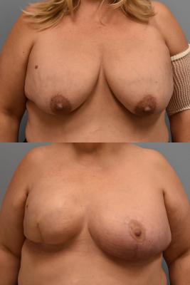 RIGHT BREAST TISSUE EXPANDER AND ADMG RAFT; RIGHT MASTOPEXY