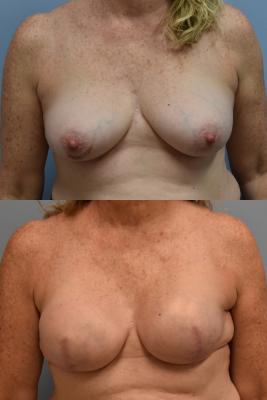 BREAST RECONSTRUCTION