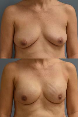 BREAST RECONSTRUCTION