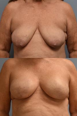 BREAST RECONSTRUCTION WITH TISSUE EXPANDER AND ADM GRAFT