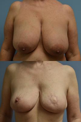 BREAST RECONSTRUCTION