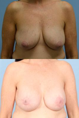 BREAST RECONSTRUCTION