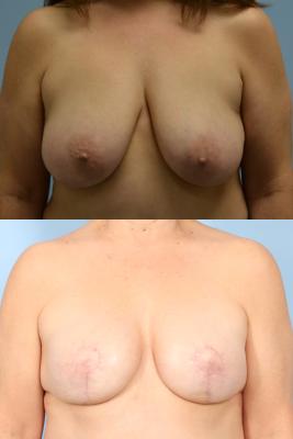 Breast Reconstruction