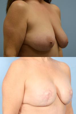 Breast Reconstruction