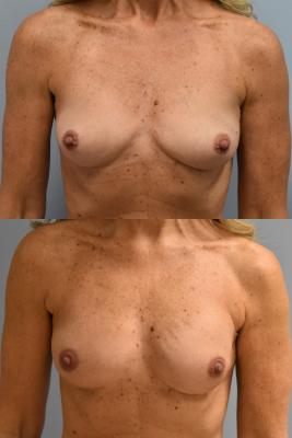 Breast Reconstruction