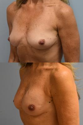 Breast Reconstruction