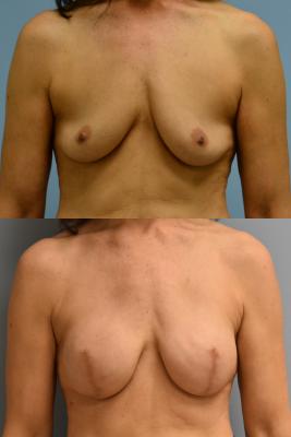 Breast Reconstruction